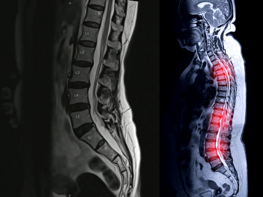 脊柱管狭窄症に悩む方への自費リハビリの提案の画像